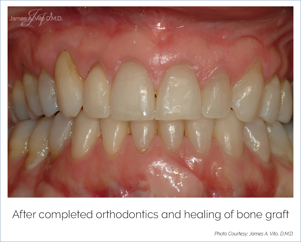 JAMES A VITO DMD Bone Grafting Before & After